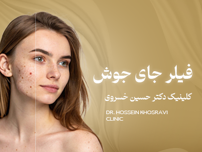 تزریق ژل برای جای جوش در شیراز | هزینه، عوارض و ماندگاری فیلر
